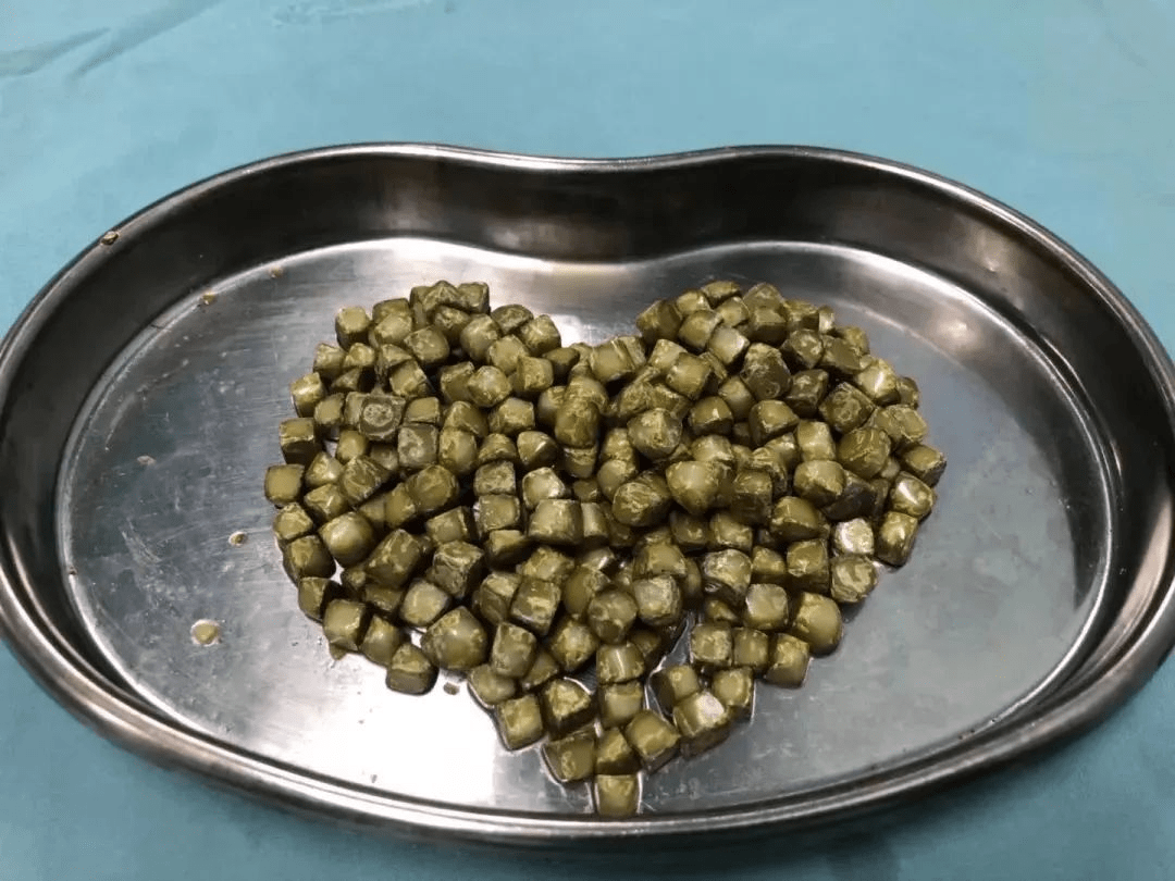 不会,"水垢"的主要成分是碳酸钙和氢氧化镁的混合物,而肾结石的主要