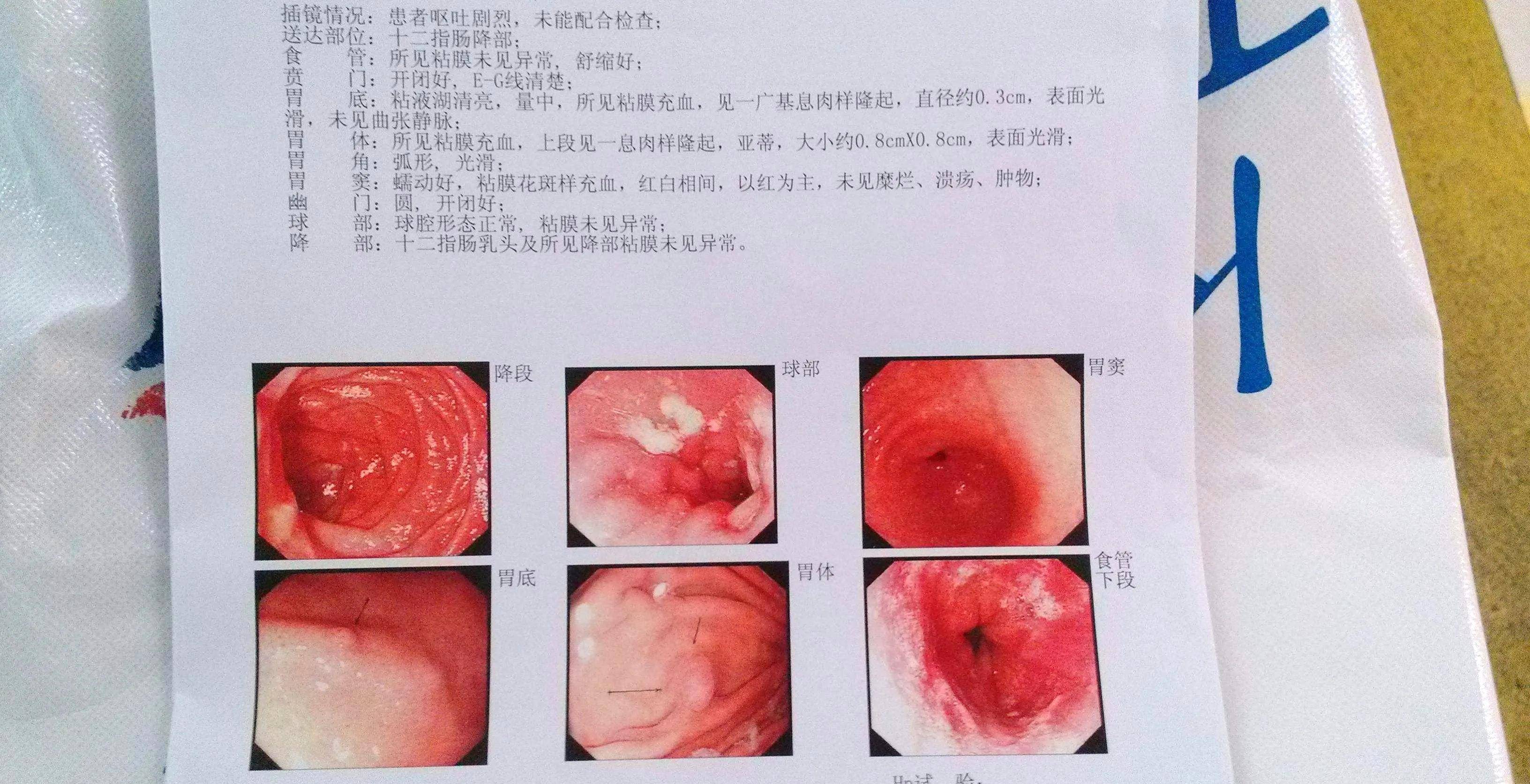 说自己体检时因胃不舒服所以做了个胃镜,结果胃镜报告说他有胃息肉
