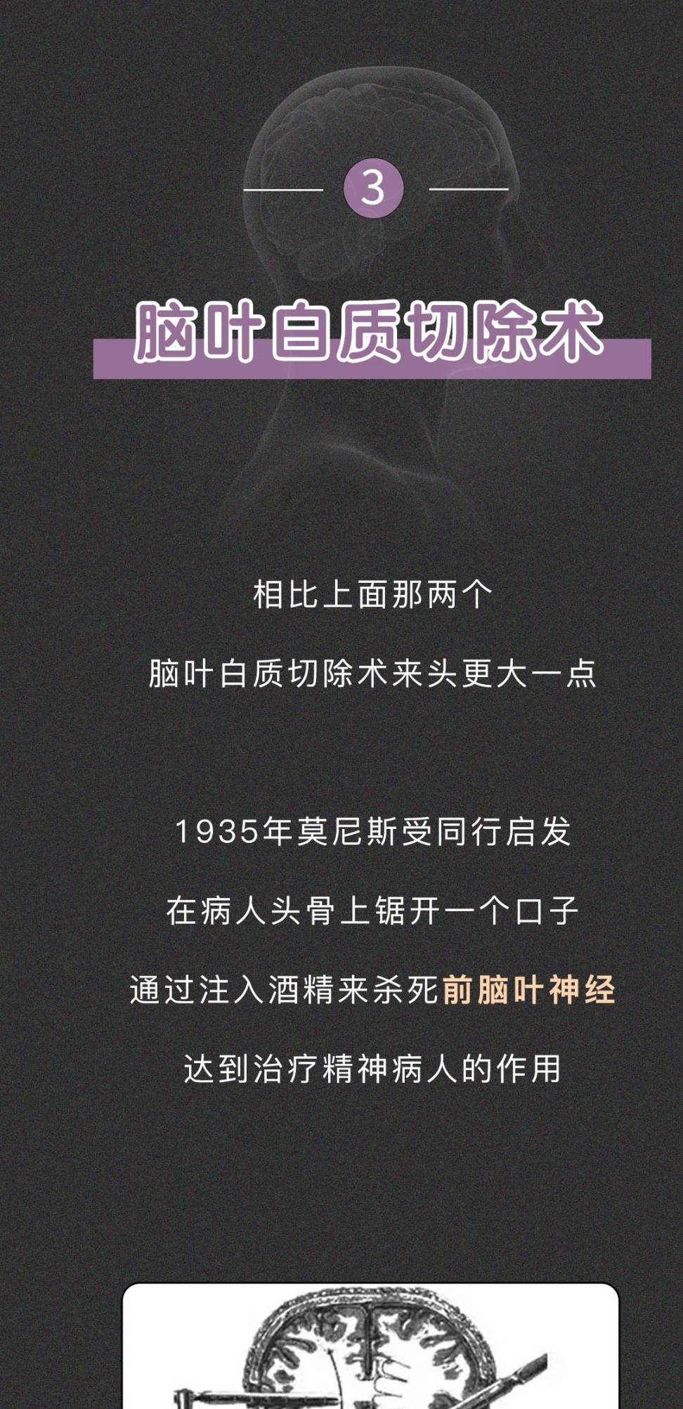 tips:1其實很多電影裡都暗戳戳地提到過這個腦葉白質切除術,小李子演