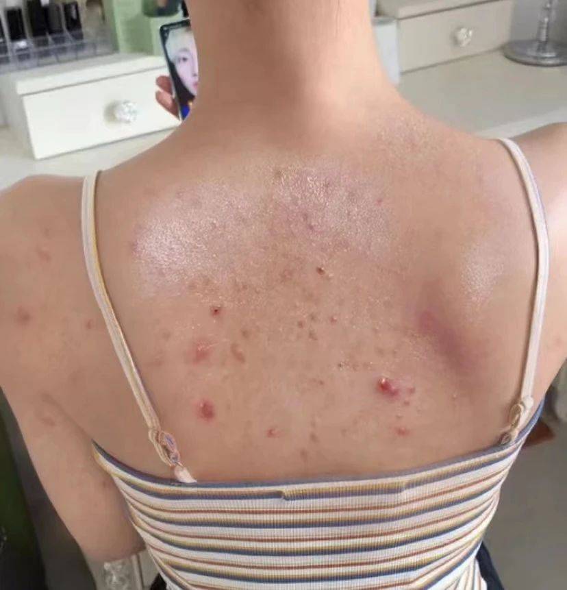 3大居家祛除法,不痘痘脓包气好不了!_后背_皮肤_祛痘