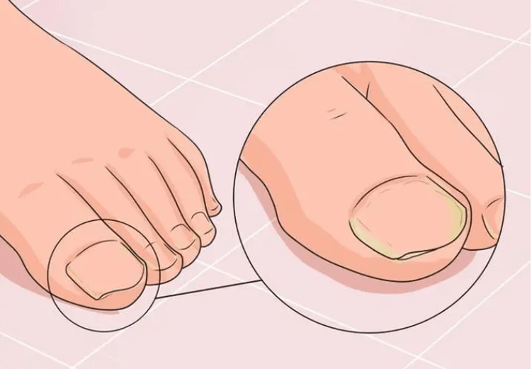 灰指甲怎么治疗除根用什么药?_方法_鞋袜_鞋子