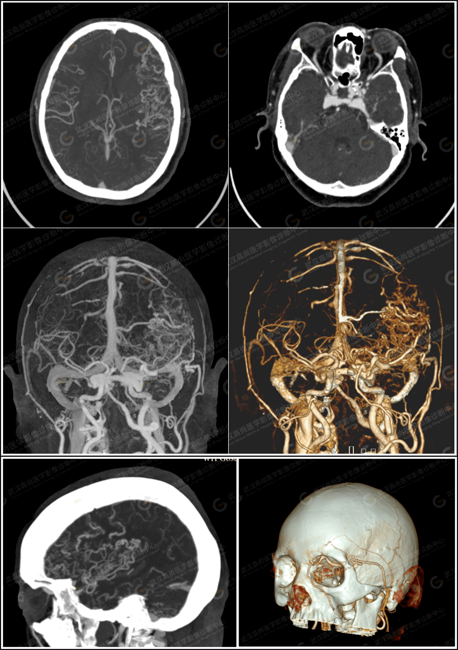 两天后申请头颅cta检查,cta图像所示:2,双侧眼球轻度突出,双眼内直肌