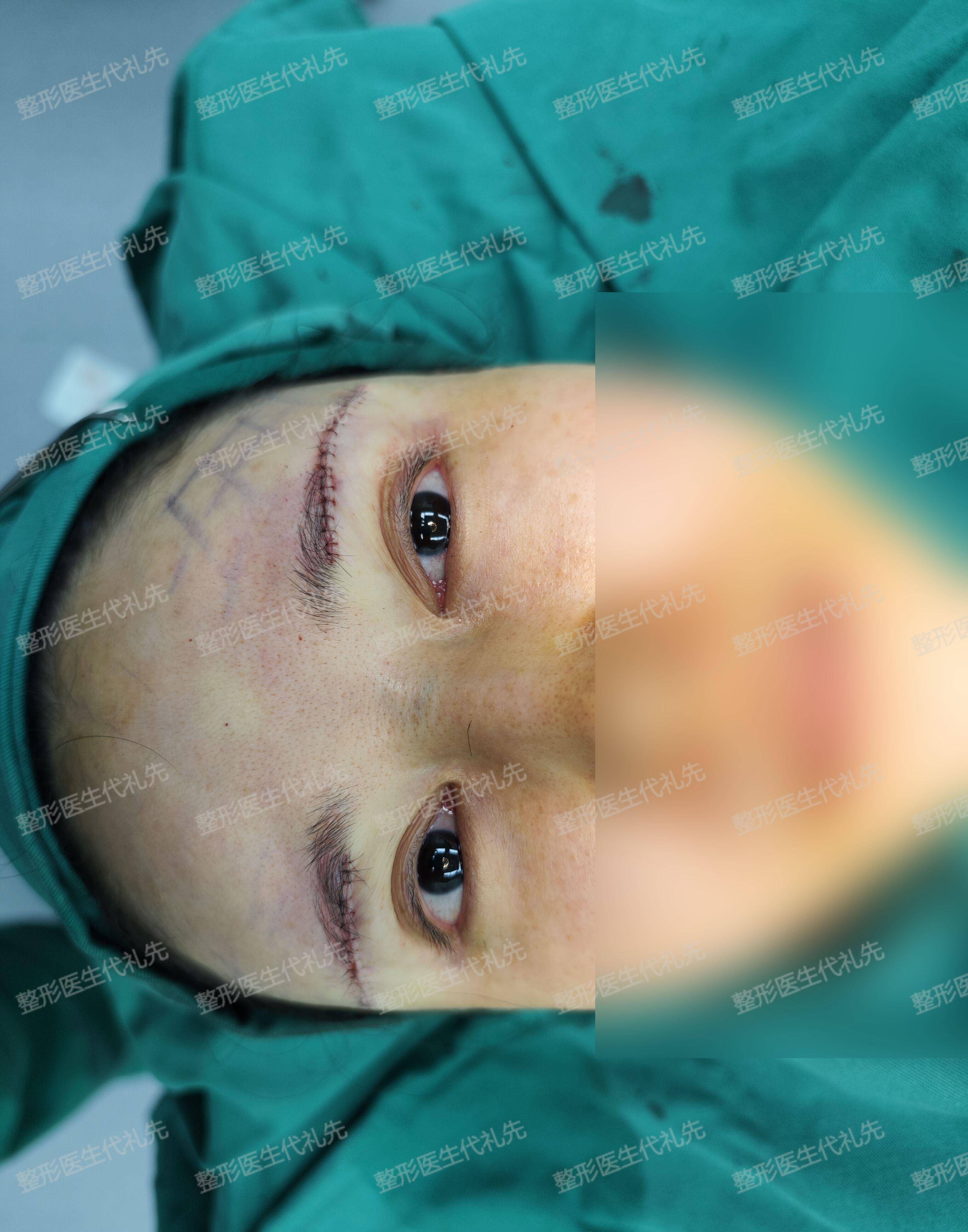 43岁女士来北京做了筋膜悬吊提眉手术,术后2周高清照片对比