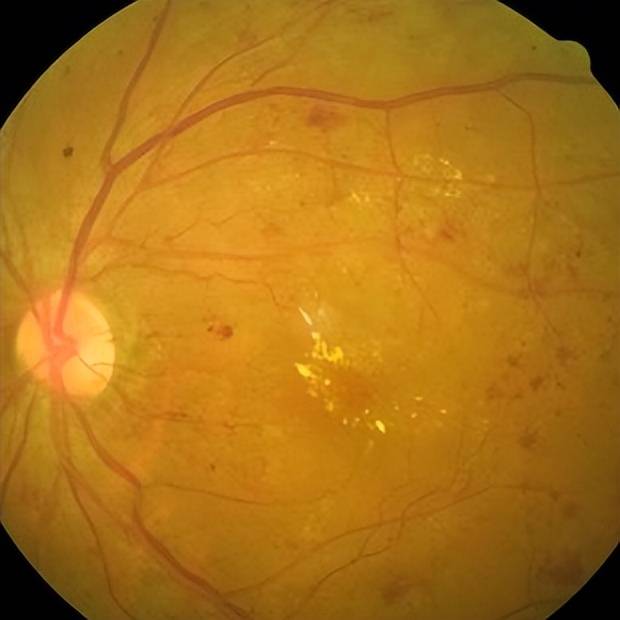 南阳南石眼科 | 科普:糖尿病视网膜病变_血管_眼底_检查