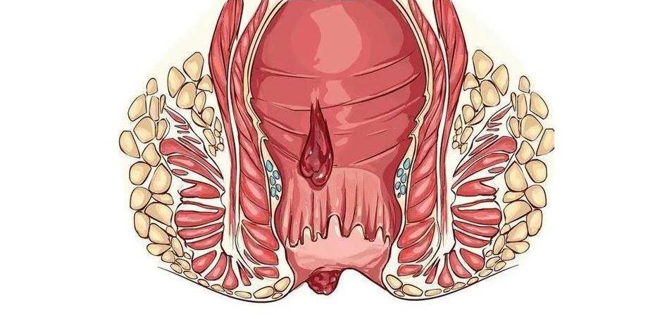 女性肛管癌的症状图片