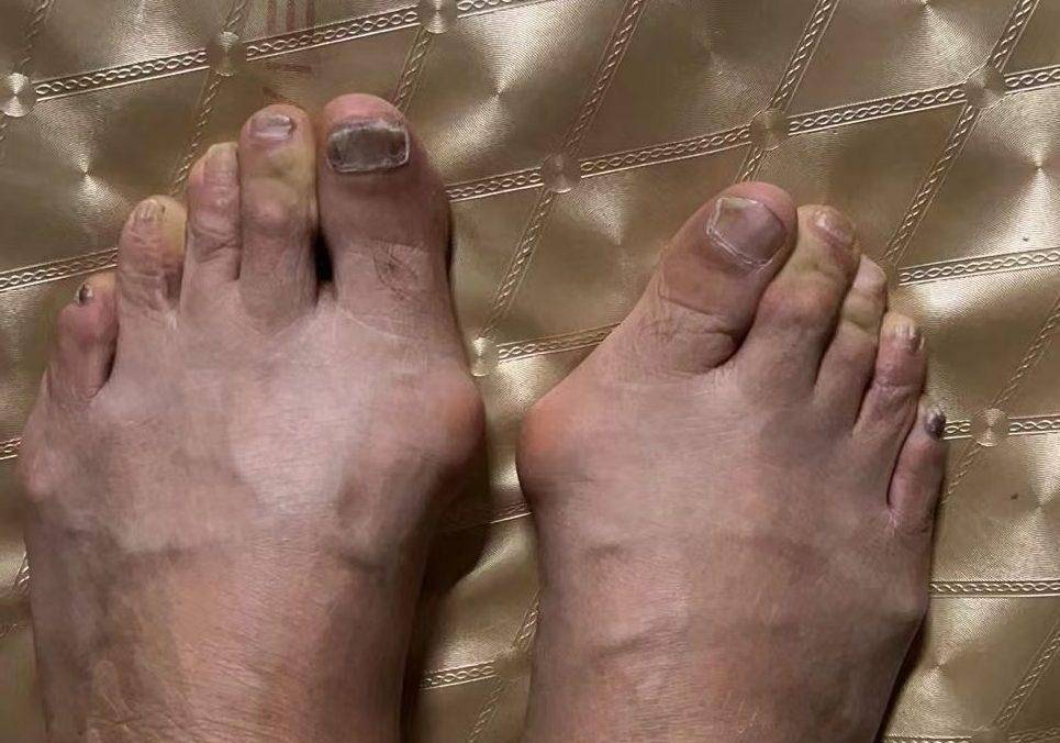 导致拇外翻的原因是什么,听拇外翻医生来说_关节_高跟鞋_时候