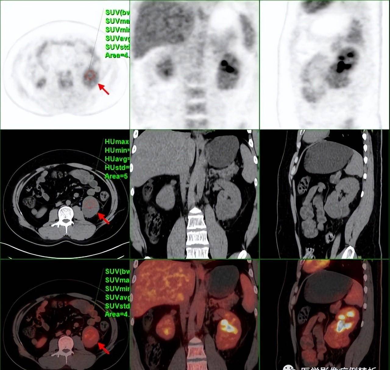 vhl综合征(林岛综合征)pet-ct影像诊断及鉴别诊断_病变_代谢_分析