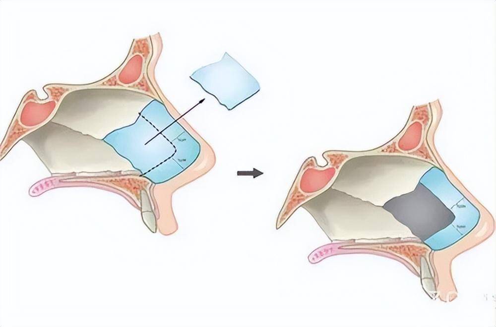 鼻中隔隆鼻的后遗症你都知道哪些!_整形_手术_软骨