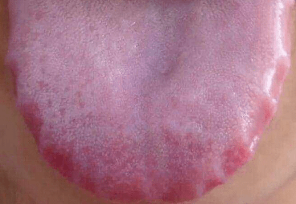 舌头是内脏健康的显示器