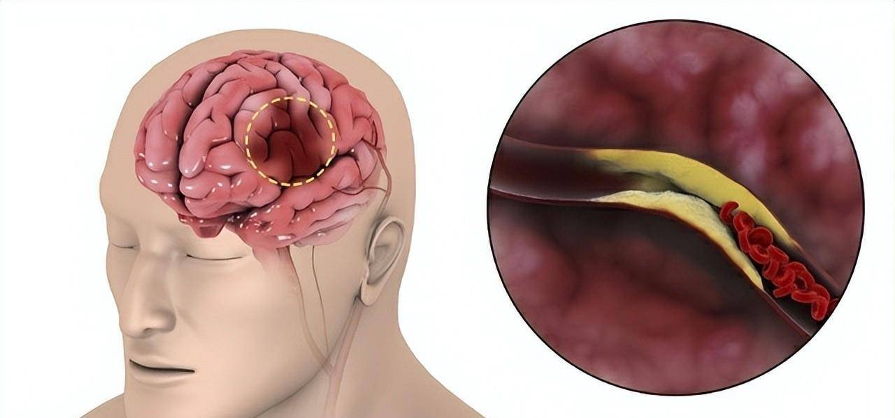 脑梗位置图片图片