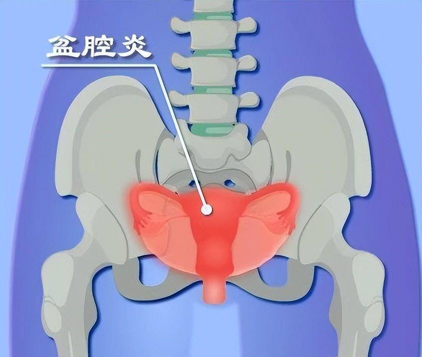 盆腔粘连,慢性盆腔炎,输卵管阻塞,日后可能会发生不孕或者异位妊娠