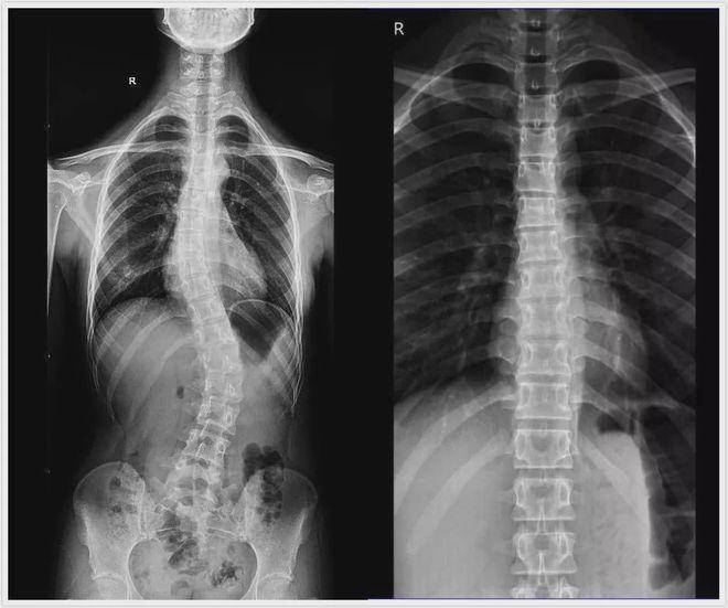 先天性脊柱裂x光图片图片