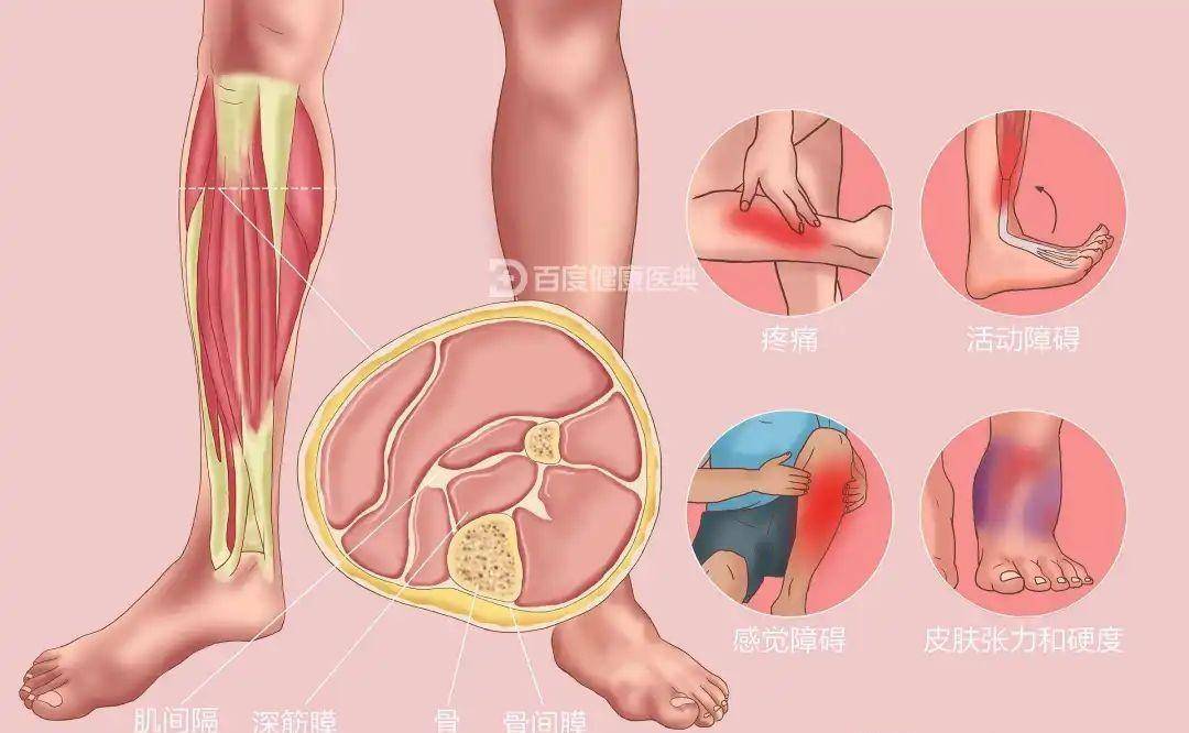 骨折术后常见并发症及护理措施_分类_暴力_部位