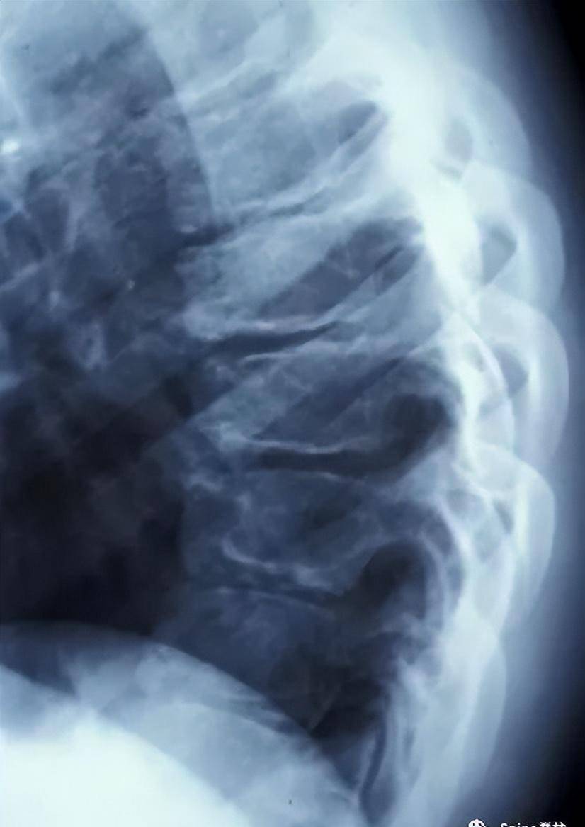 scheuermann病(休门氏病)