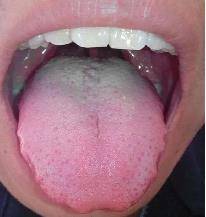 舌头中间凹陷图片