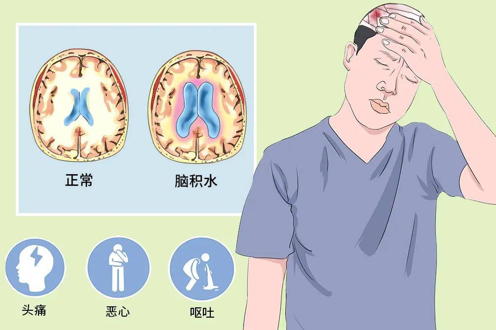 脑积水有什么症状02脑和脊髓悬浮在脑脊液中