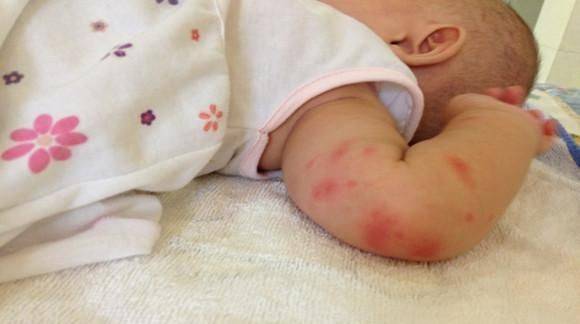 宝宝被蚊子咬了怎么快速止痒和护理(附3种方法消肿止痒)