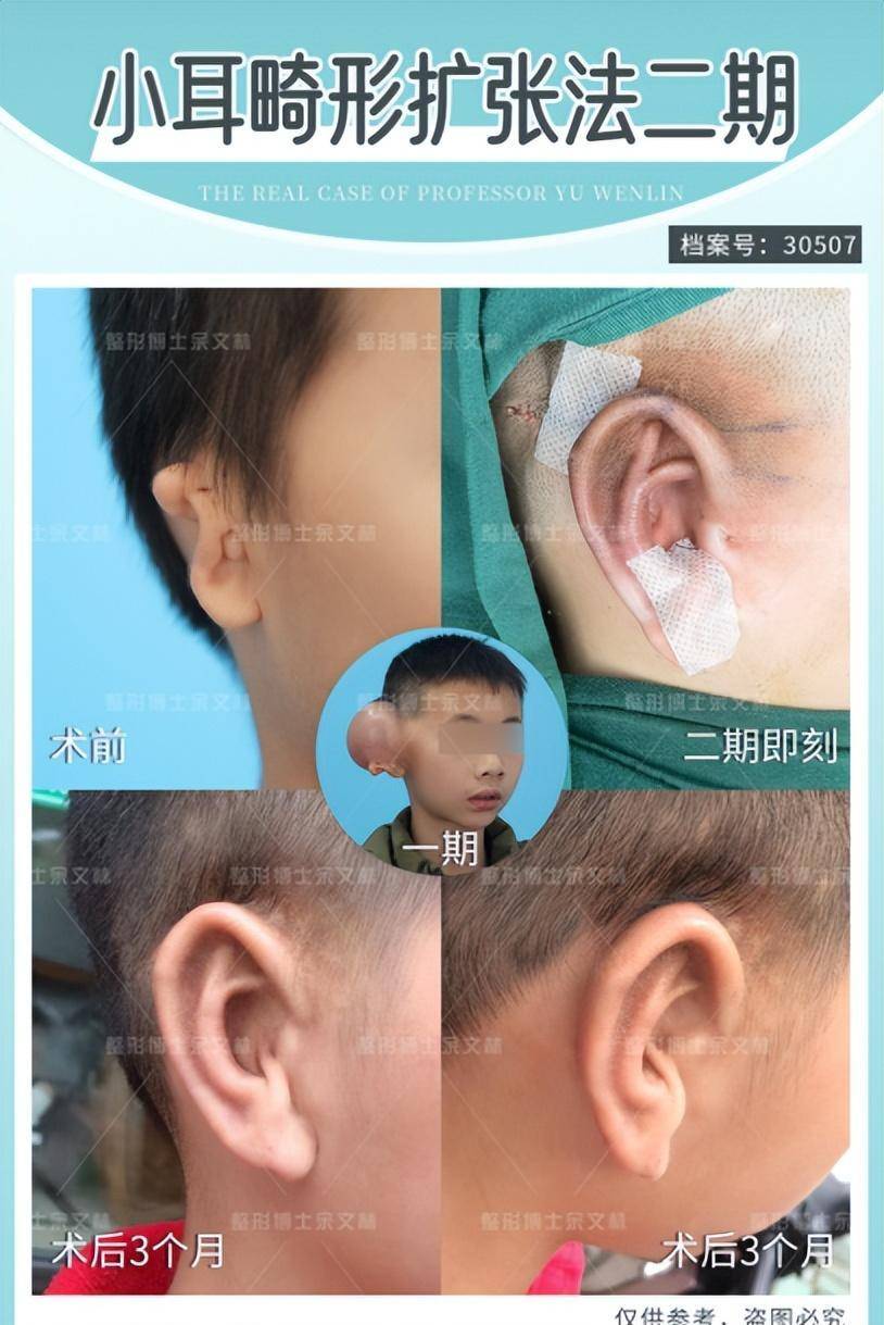 小耳畸形小孩佩戴义耳可以吗?不建议!_患者_面部_耳廓