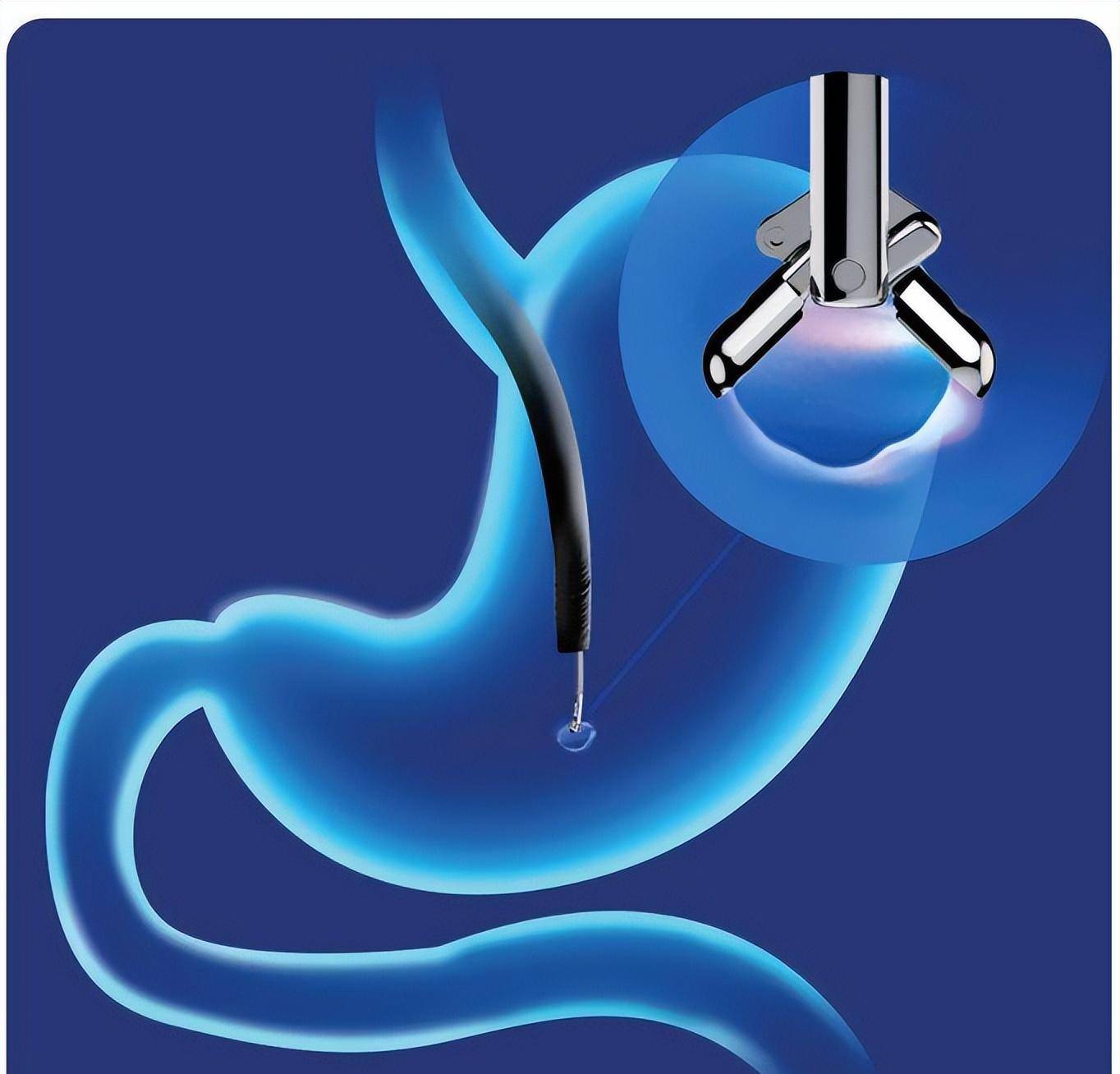 活检示意图内镜诊断 病理诊断