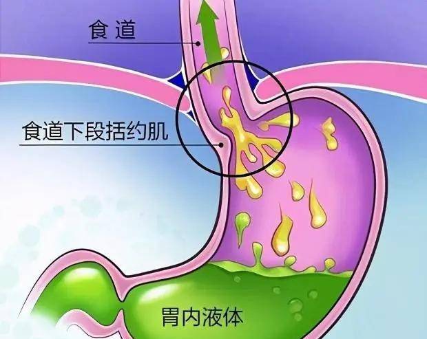 粉丝提问:胆汁反流和食管反流有什么区别?反反复复就是用错药!