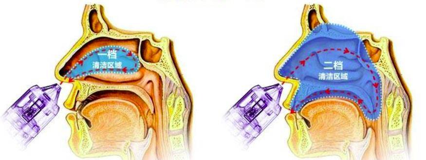 鼻窦炎排脓姿势图片