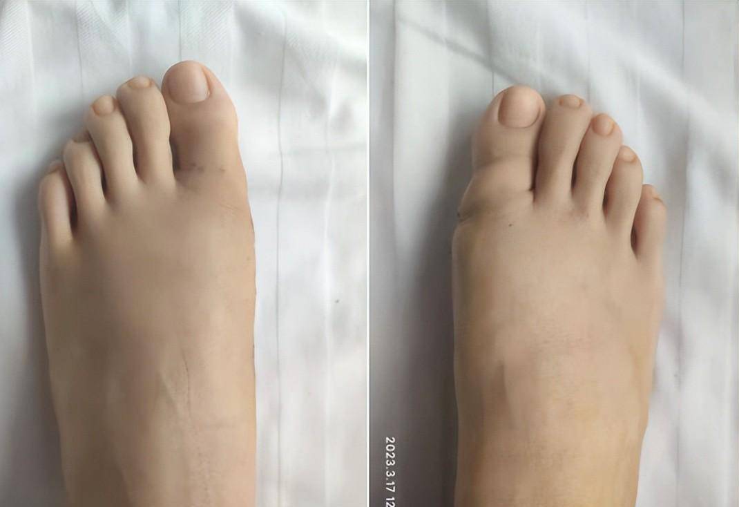 山东33岁王女士做完拇外翻手术2个月,给大家来点"干货"分享!