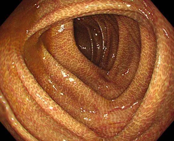 "结肠黑变病:你的肠道也会变色!"_患者_发病_泻药