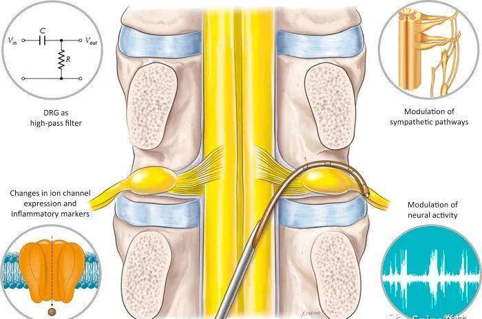 applications)drgs相关文献共4482篇背根节电刺激导线放置示意图