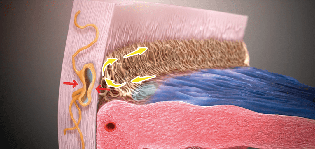 管成形术(microcatheter-assisted trabeculotomy,mat)微导管辅助的
