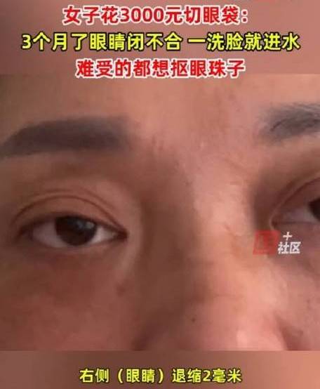 女子3千割眼袋3个月眼睛闭不合 割眼袋有哪些风险