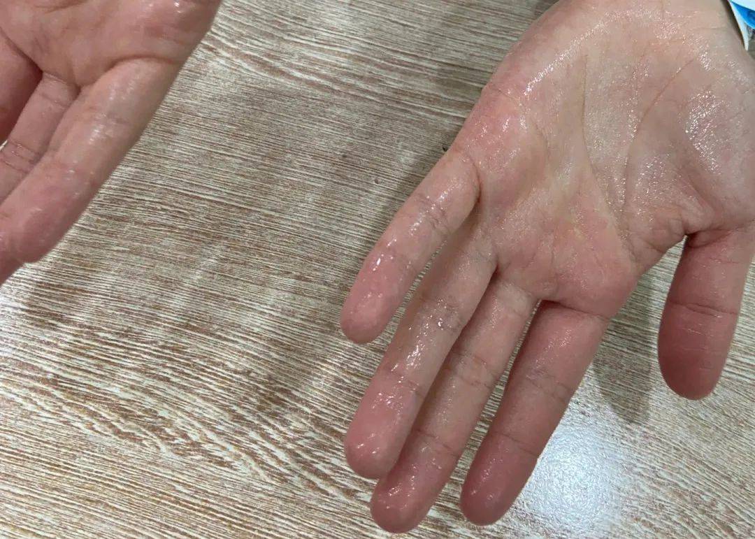 患者自诉:我与手汗症的"爱恨情仇"_手术_生活_工作
