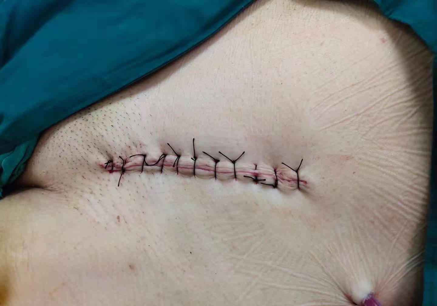 医学小科普丨静注右美托咪定在上腹部正中切口手术麻醉中如何应用