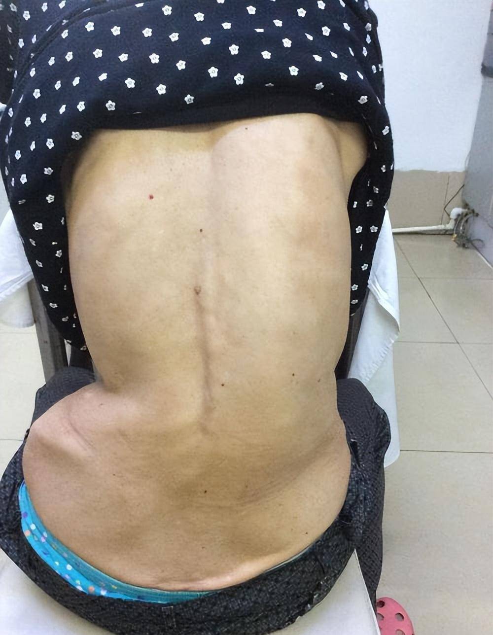 胸腰椎结核在脊柱结核中最为常见,往往引起疼痛,严重的脊柱畸形,神经