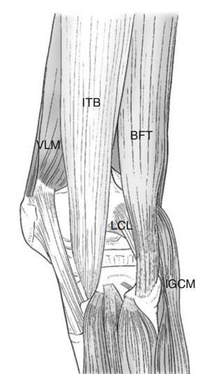 腘肌腱和弓形韧带形成后外侧支撑结构.