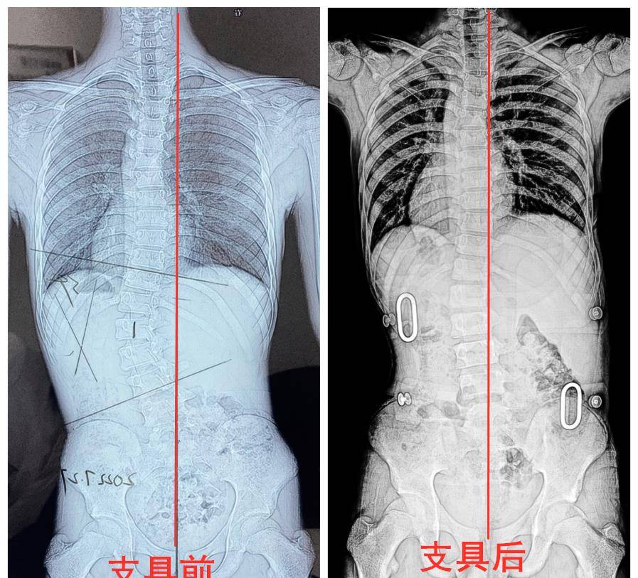 脊柱侧弯参加3天强化班后,剃刀背减少2°,中线基本回直!