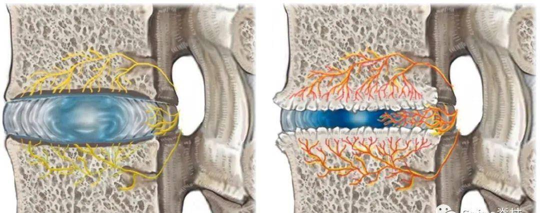 schmorl结节伴骨髓水肿(典型mri)_病变_纤维_造影