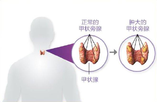 钻研甲状旁腺诊疗技术,为患者谋福音_治疗_甲状腺_继发性