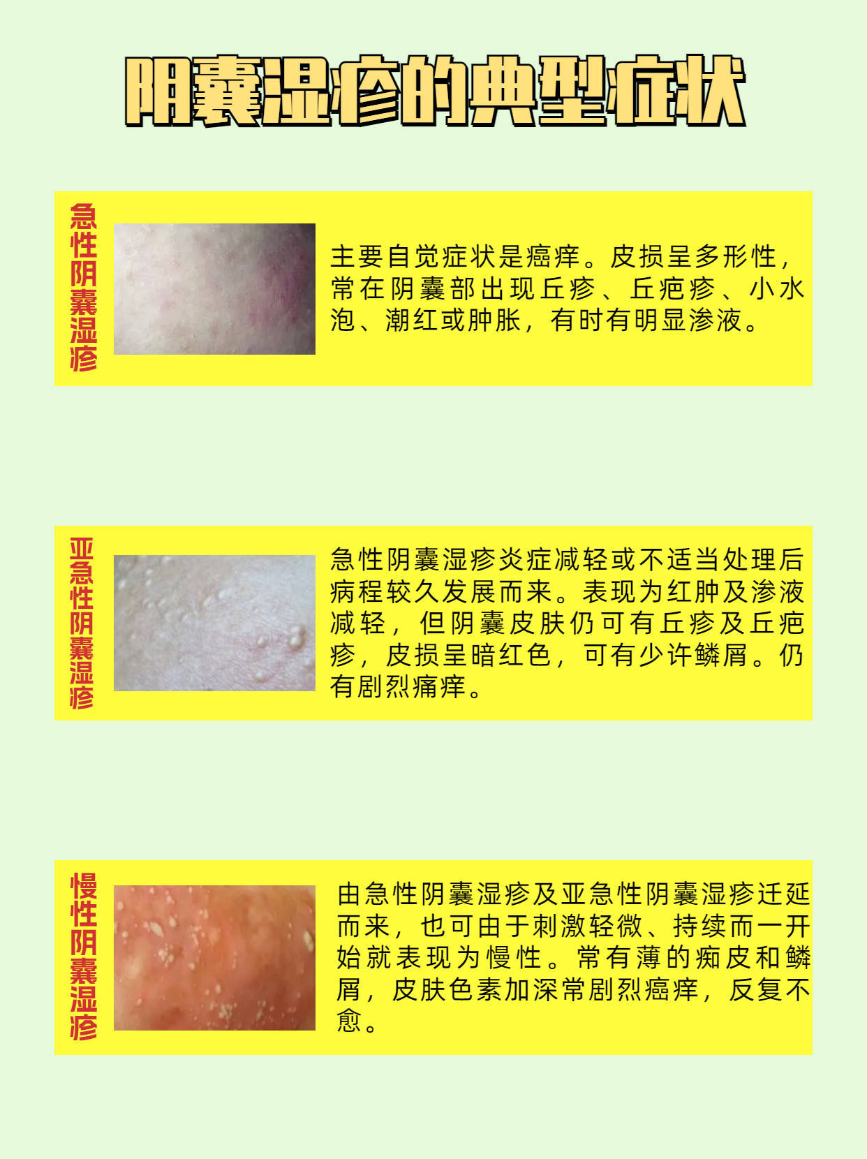 阴囊湿疹症状两侧图片