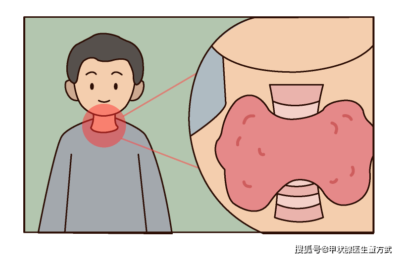 甲状腺结节健康科普（甲状腺结节的健康指导内容）
