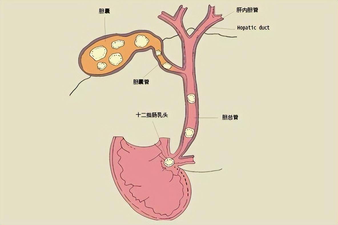 以前都是保胆取石,为啥现在查出胆结石,就要切除胆囊?