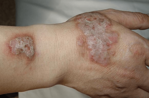 入夏后湿疹患者逐渐增多,皮肤敏感患者如何顺利度夏?