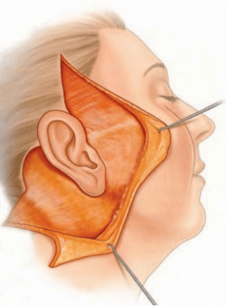 曝光了~脸部拉皮手术全过程,小拉皮手术全过程~_皮肤_效果_面部