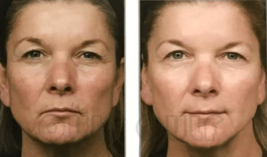 细说:悦升线提升苹果肌,意大利悦升线效果保持几年_皮肤_细胞_面部