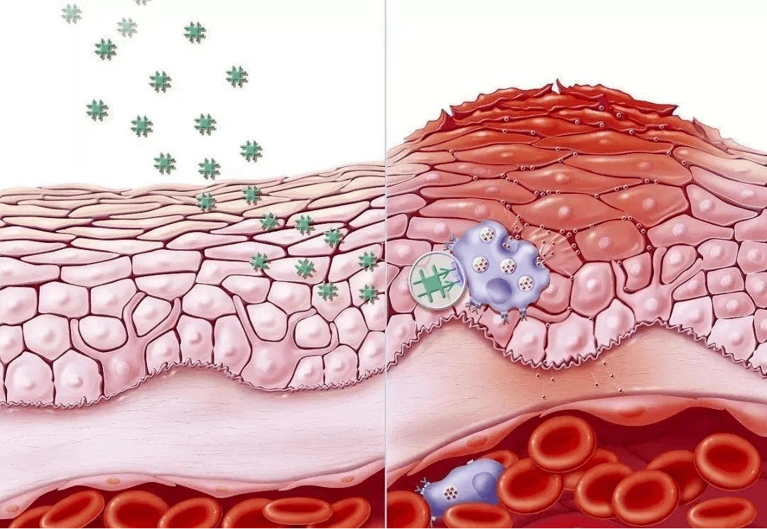 疾病科普|通俗易懂的说下身体的"炎症"到底是怎么一回事?