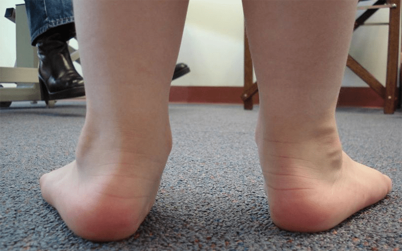 狮博士:所有小孩一出生就是扁平足?_孩子_足部_进行