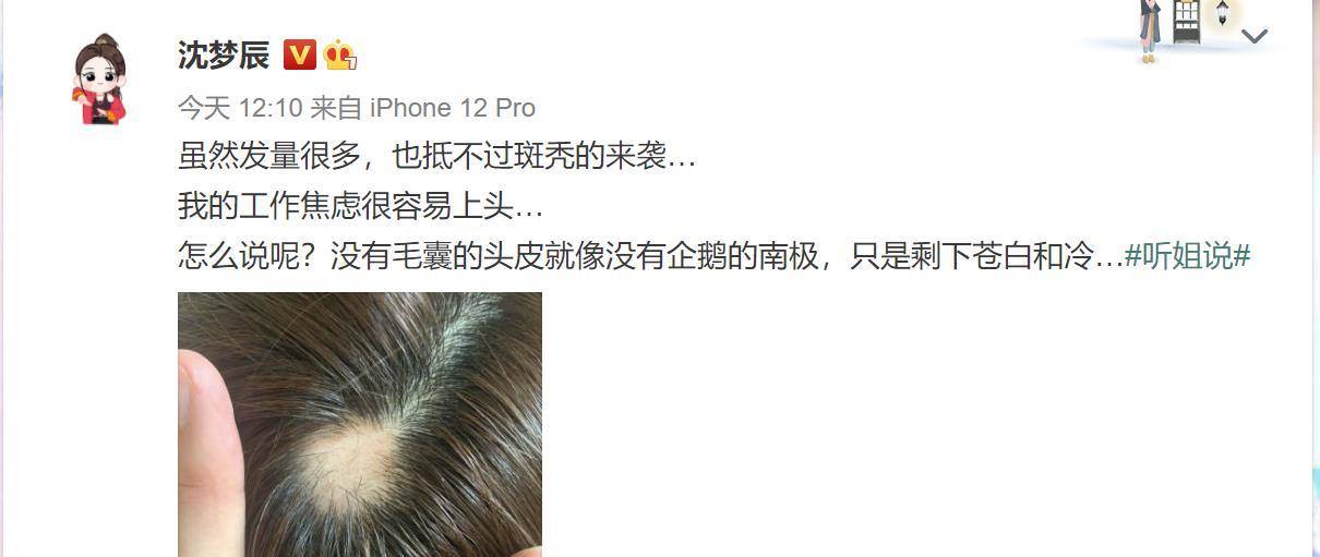 沈梦辰自曝秘密:因工作焦虑而斑秃,网友:太拿粉丝不当外人了_杜海涛