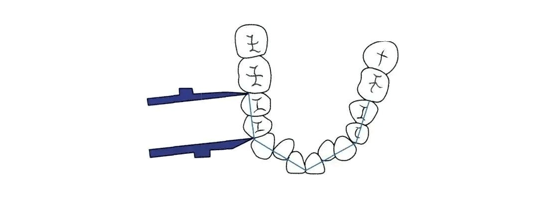 正畸培训| 正畸临床模型牙齿拥挤度的测量方法_弧形_长度_间隙