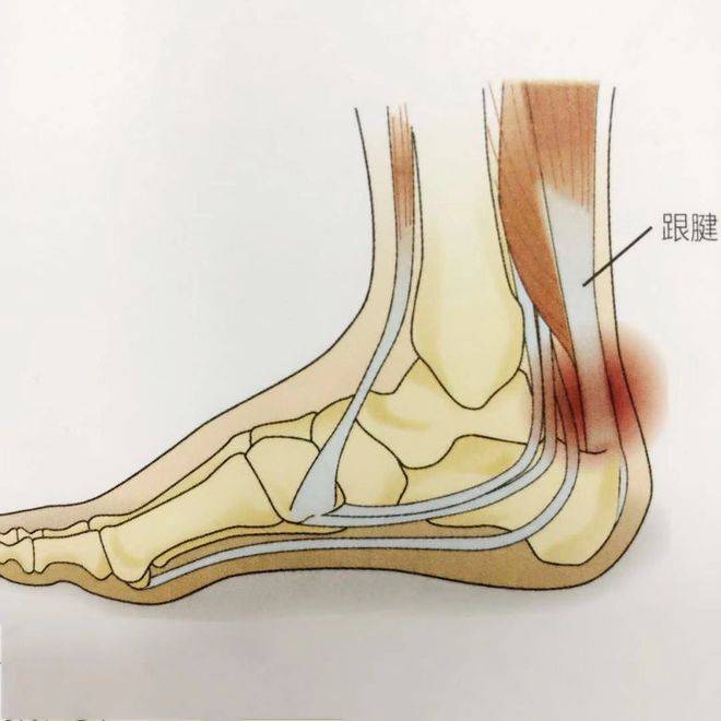 跟腱炎可以做小針刀手術嗎?_患者_進行_治療