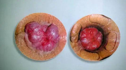 痔核脱出:当痔疮严重时,痔核可能会从肛门脱出,这不仅给患者带来即篌