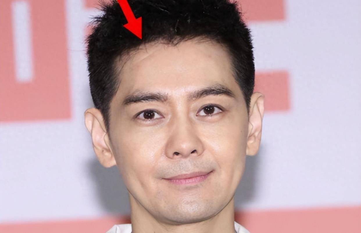 林志颖事故后首露疤痕,面部凹陷皮肤分层似面具,一度眼睛险失明_额头